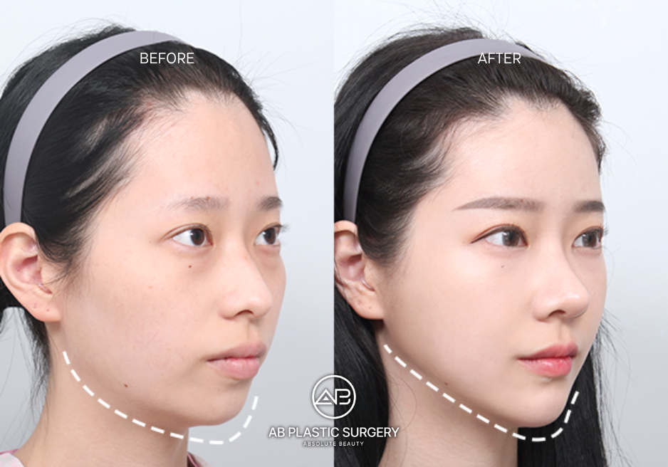 韓国での顎整形手術