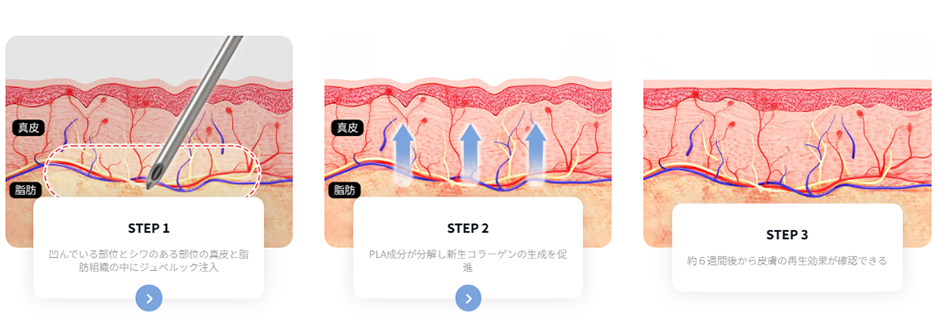 ジュべルック施術原理