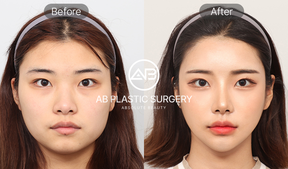 韓国Vライン整形のビフォーアフター写真