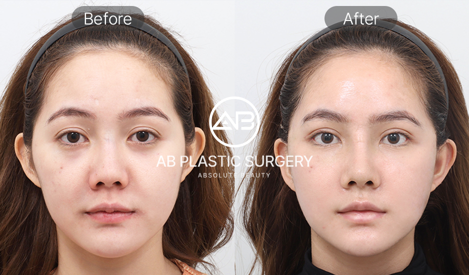 Vライン整形のビフォーアフター比較