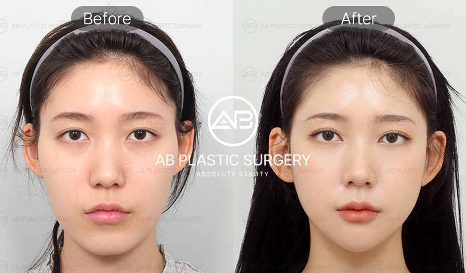 韓国Vライン整形手術の結果
