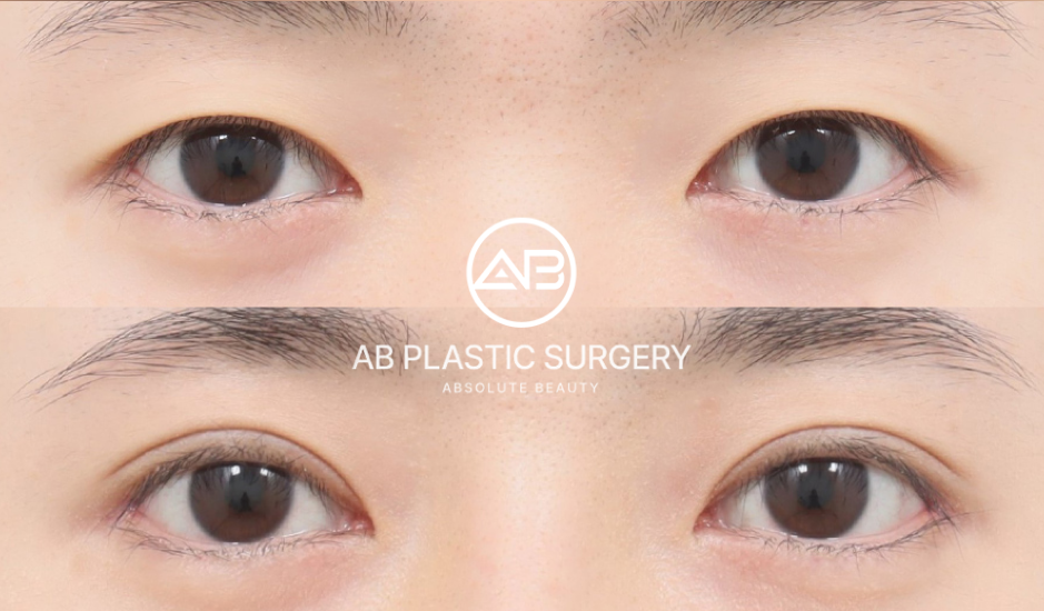 アーモンドアイ整形のビフォーアフター写真