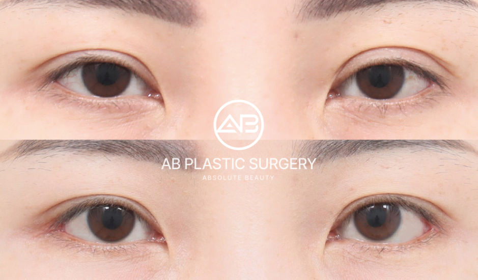 アーモンドアイ整形のメリットと注意点