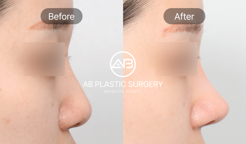 韓国忘れ鼻整形のビフォーアフター写真