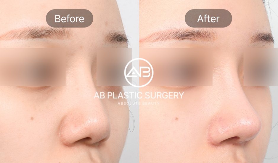 自然に顔立ちに馴染む韓国の忘れ鼻整形