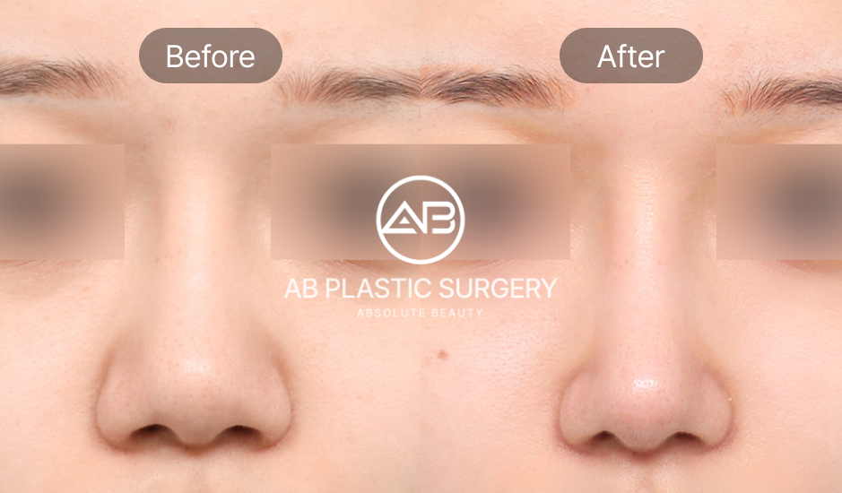 鼻整形のビフォーアフター正面比較写真