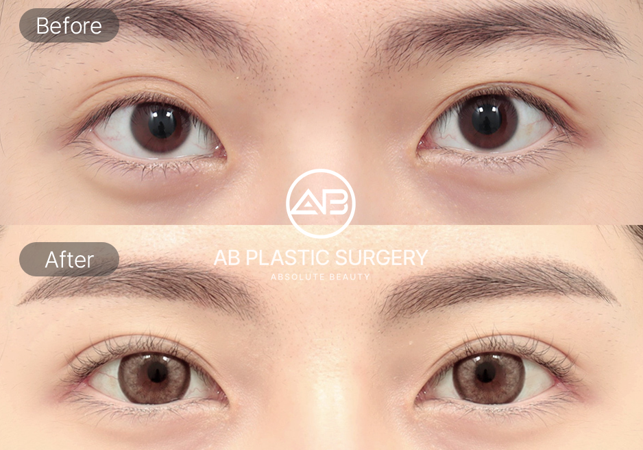 アーモンドアイ整形