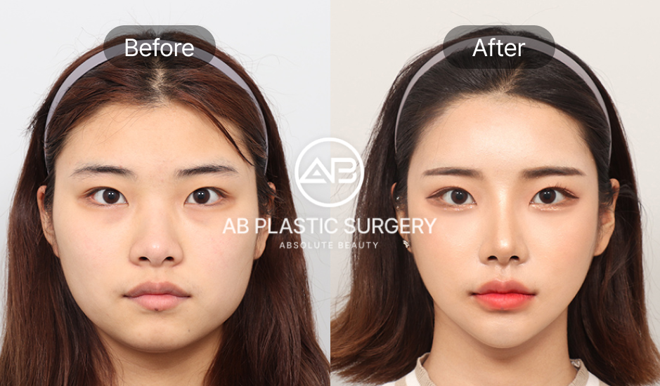 韓国のVライン整形のビフォーアフター写真
