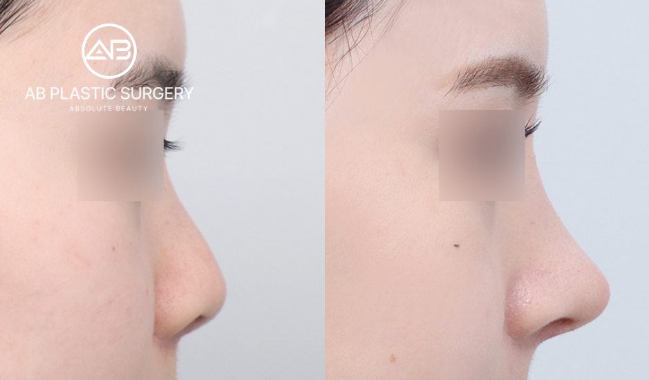 AB美容外科での鼻整形のビフォーアフター（横からのアングル）