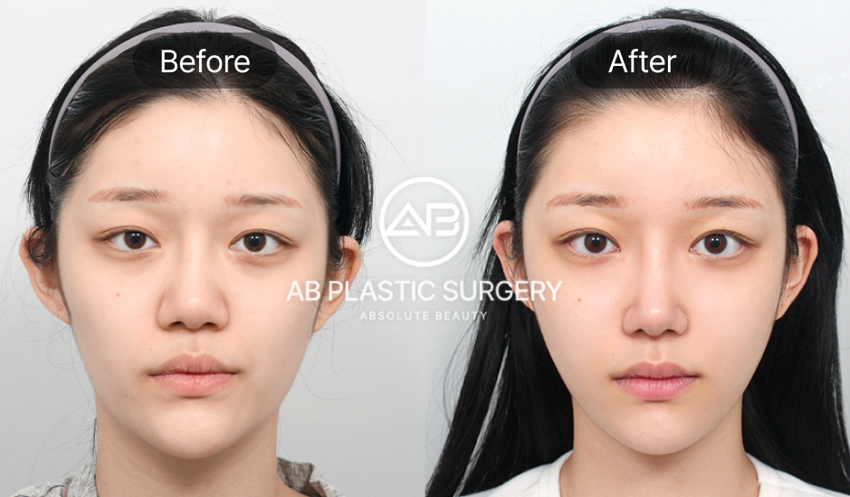 韓国整形の施術結果