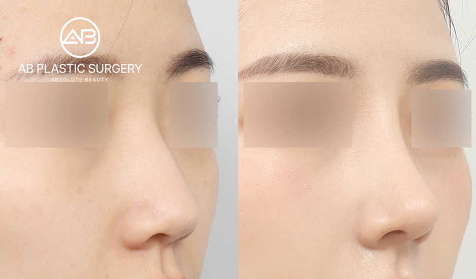 AB美容外科での自然な鼻整形の仕上がりを比較｜韓国鼻整形、スロープ型、レビュー、シリコン、軟骨