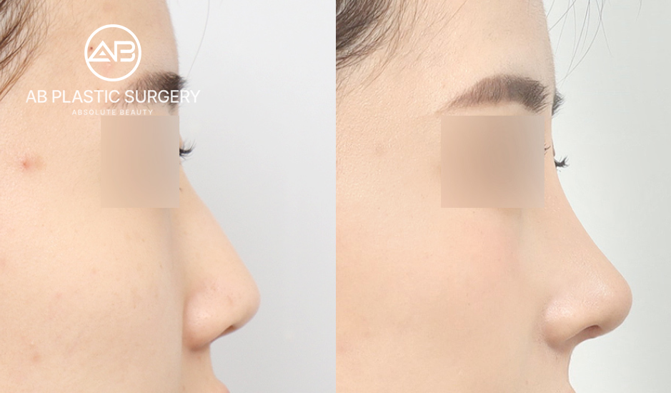 AB美容外科での鼻整形の横顔ビフォーアフター比較写真