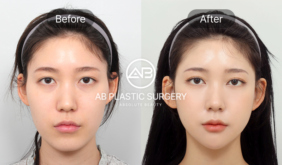 韓国の輪郭整形