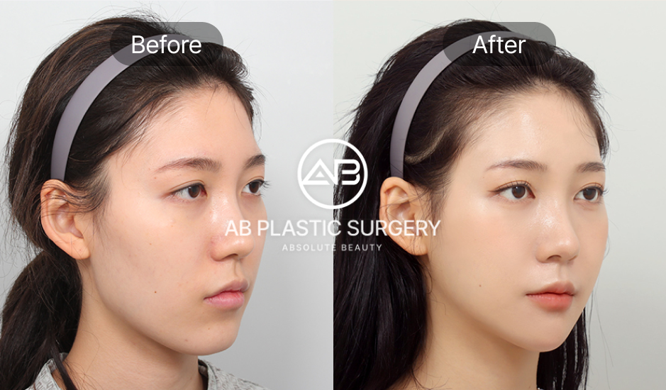 韓国の輪郭整形のビフォーアフター写真