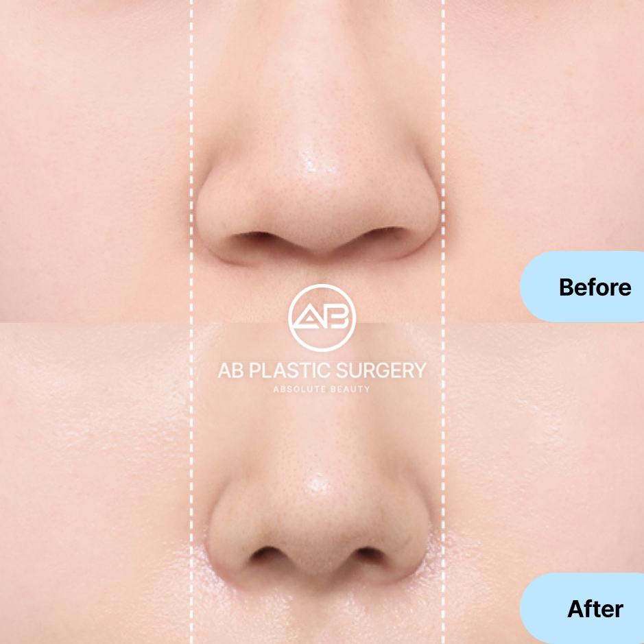 韓国AB美容外科の小鼻縮小手術のビフォーアフター画像