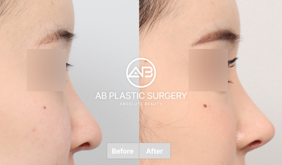 韓国AB美容外科の鼻尖形成手術のビフォーアフター画像