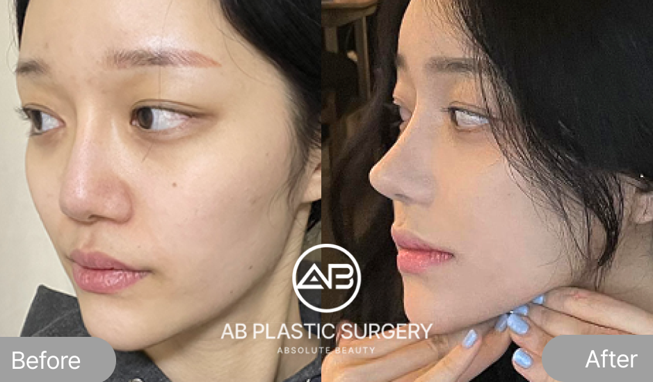 韓国AB美容外科の鼻再手術のビフォーアフター画像