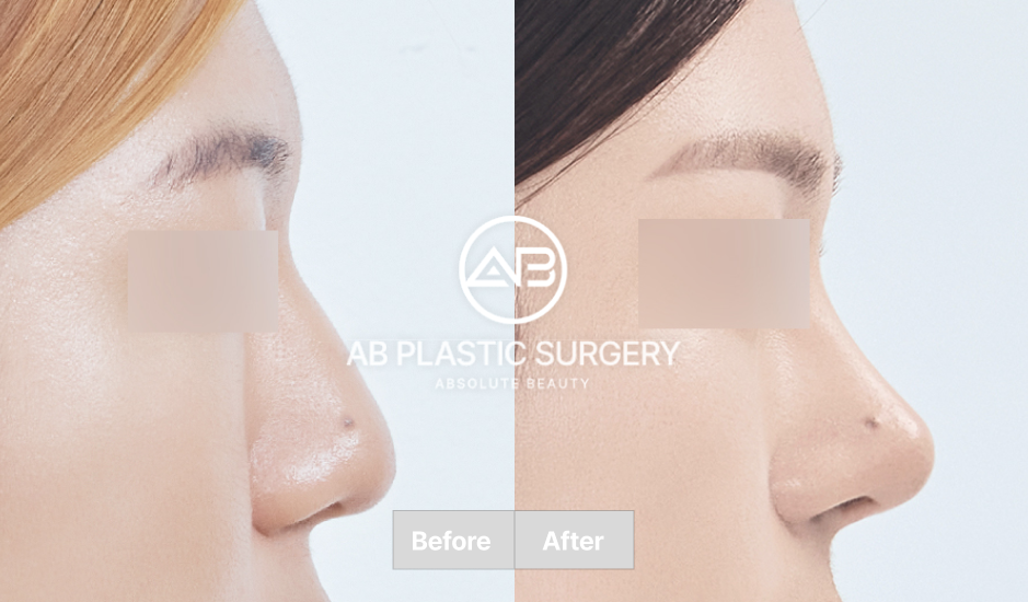 韓国AB美容外科のシリコンと耳介軟骨を利用した鼻整形のビフォーアフター画像