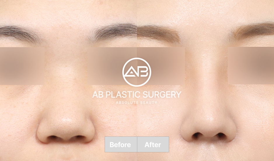 韓国AB美容外科の小鼻縮小および鼻尖形成のビフォーアフター画像