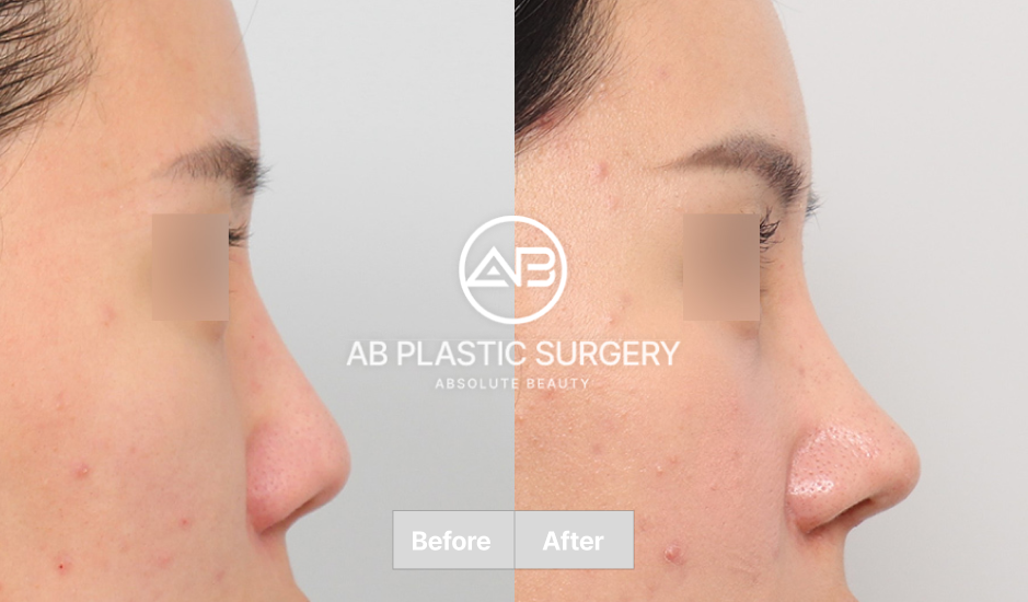 韓国AB美容外科の鼻整形再手術（修正手術）のビフォーアフター画像