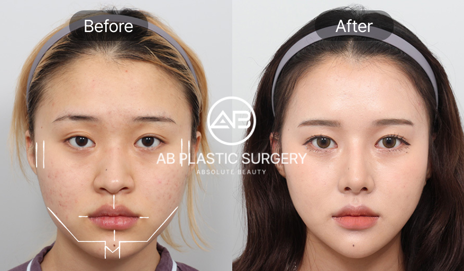 AB美容外科で輪郭3点手術を受けた女性のビフォーアフター写真