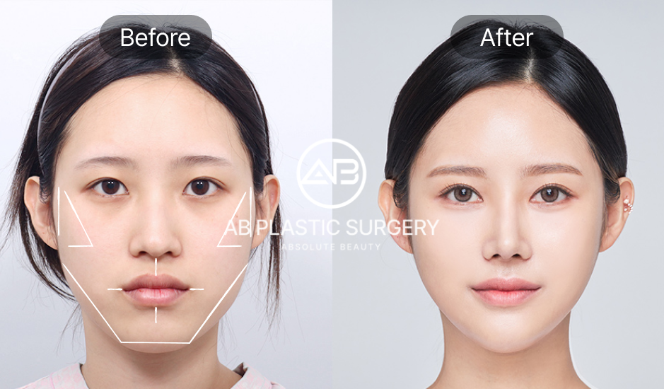 AB美容外科で輪郭3点整形を受けた女性のビフォーアフター画像