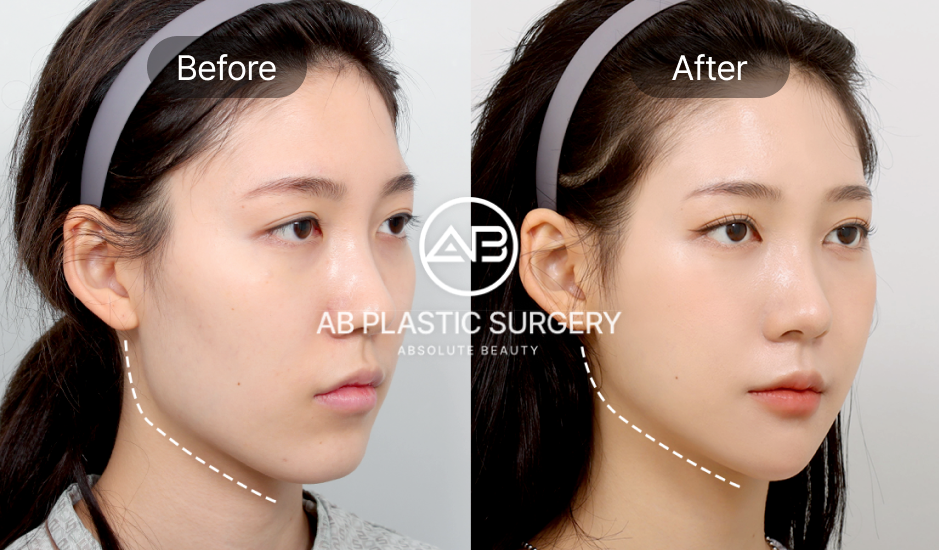 AB美容外科でエラ整形を受けた女性の横顔ビフォーアフター写真