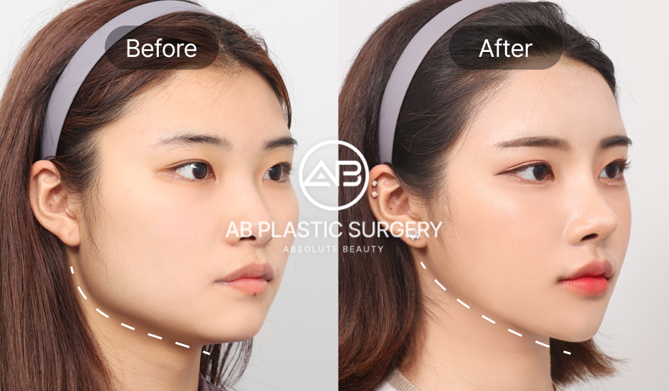 AB美容外科でエラ整形を受けた女性の斜め横顔ビフォーアフター写真