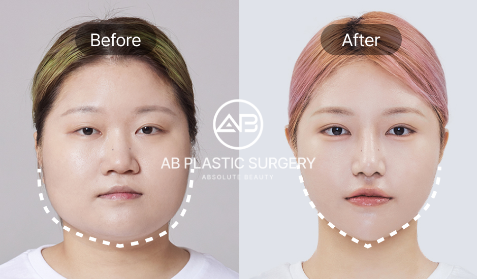 AB美容外科で輪郭手術を受けた女性の正面ビフォーアフター画像