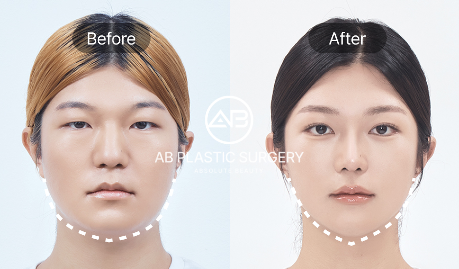 AB美容外科で輪郭整形を受けた患者の正面ビフォーアフター画像