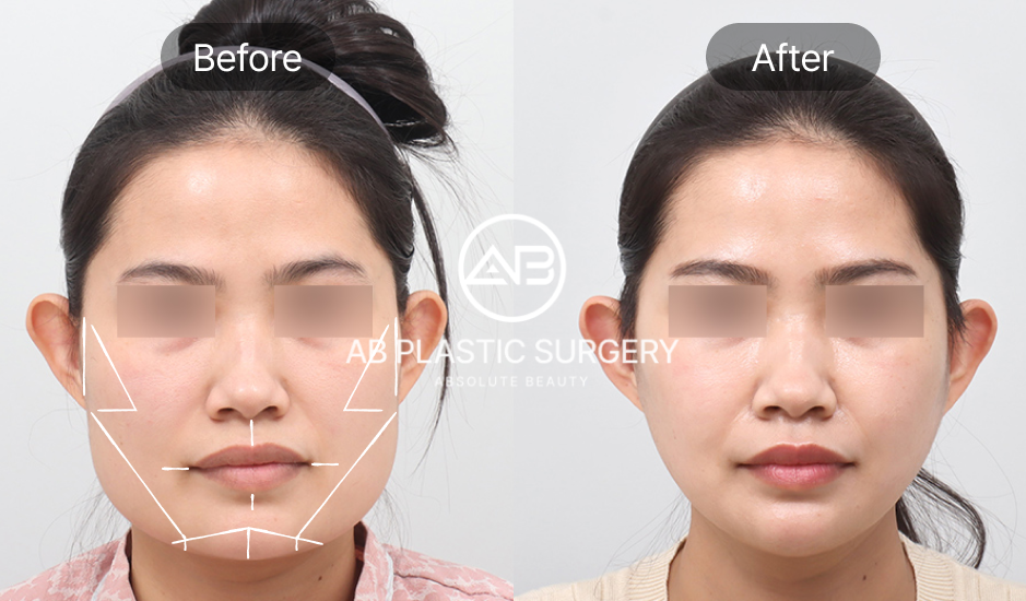 AB美容外科でエラ削りと輪郭整形を受けた女性の正面ビフォーアフター写真
