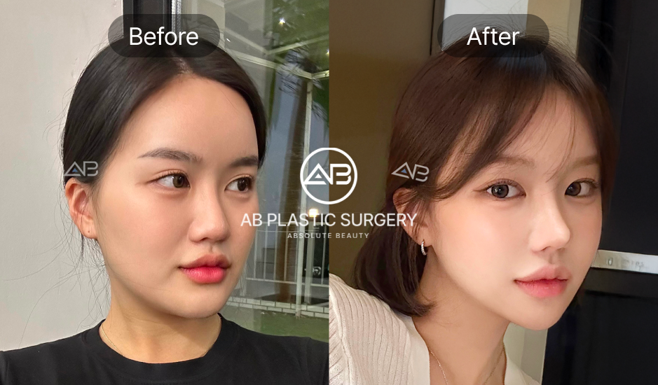 AB美容外科の構造型鼻整形のビフォーアフター