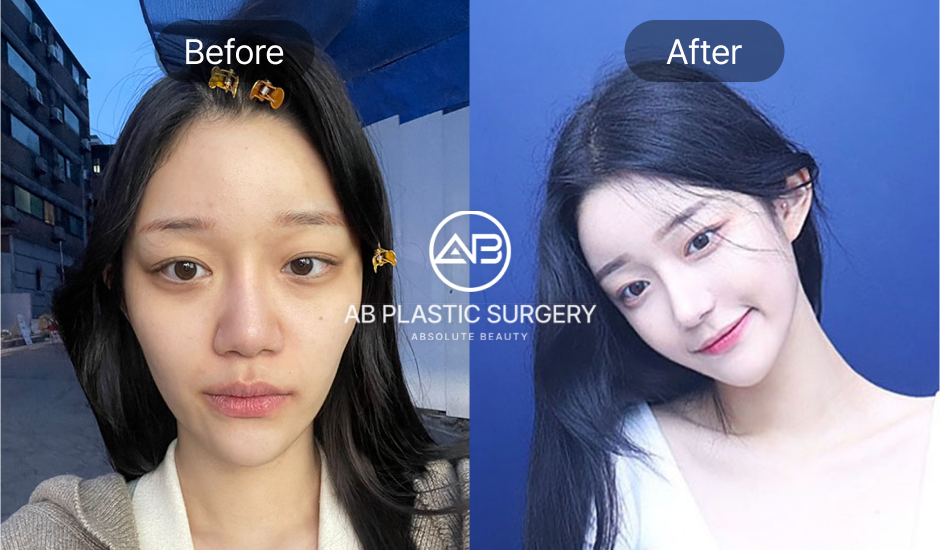 AB美容外科の輪郭3点整形によるビフォーアフター