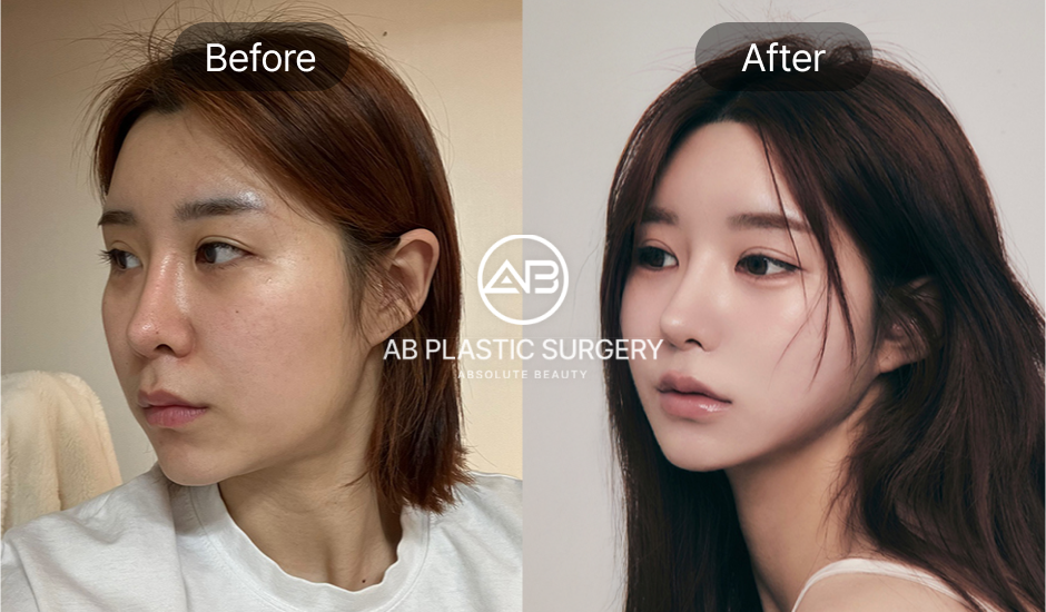 AB美容外科の短期滞在向け整形ビフォーアフター
