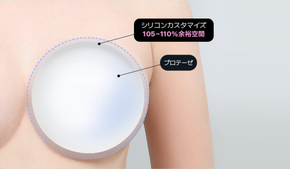 韓国豊胸シリコンバッグ設計｜AB美容外科で胸郭構造に合わせてカスタマイズされたプロテーゼサイズと挿入設計