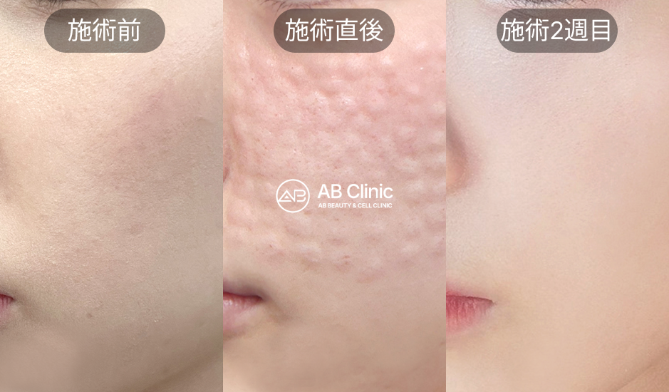 リジュラン施術のビフォーアフター – 施術前・直後・2週間後の肌変化を比較
