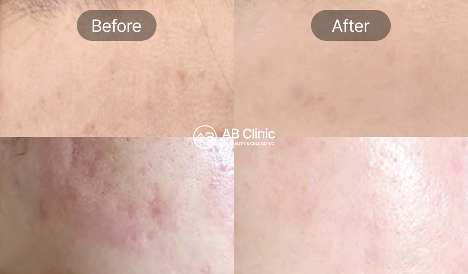 レスノベクリスタル施術のビフォーアフター – 炎症・赤み・色素沈着の改善例