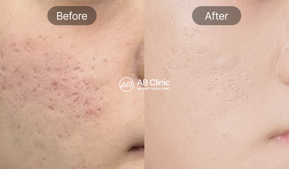 ジュベルックボリューム施術のビフォーアフター – 頬の毛穴・凹凸改善と自然なハリ回復