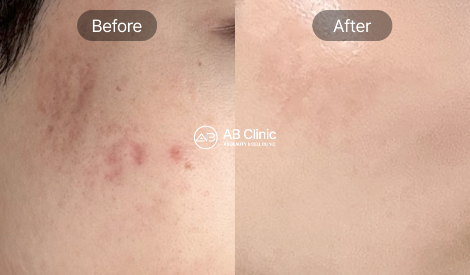 エクソソーム施術のビフォーアフター – 色素沈着・赤み・肌トーンの改善症例