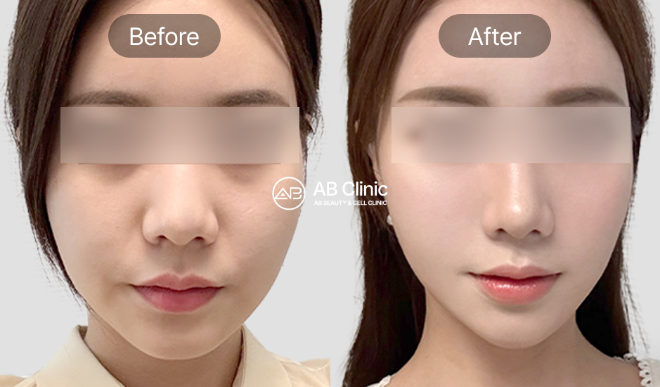 乾燥肌・ハリ不足の改善ビフォーアフター – リジュラン・レスノベ施術による肌再生効果