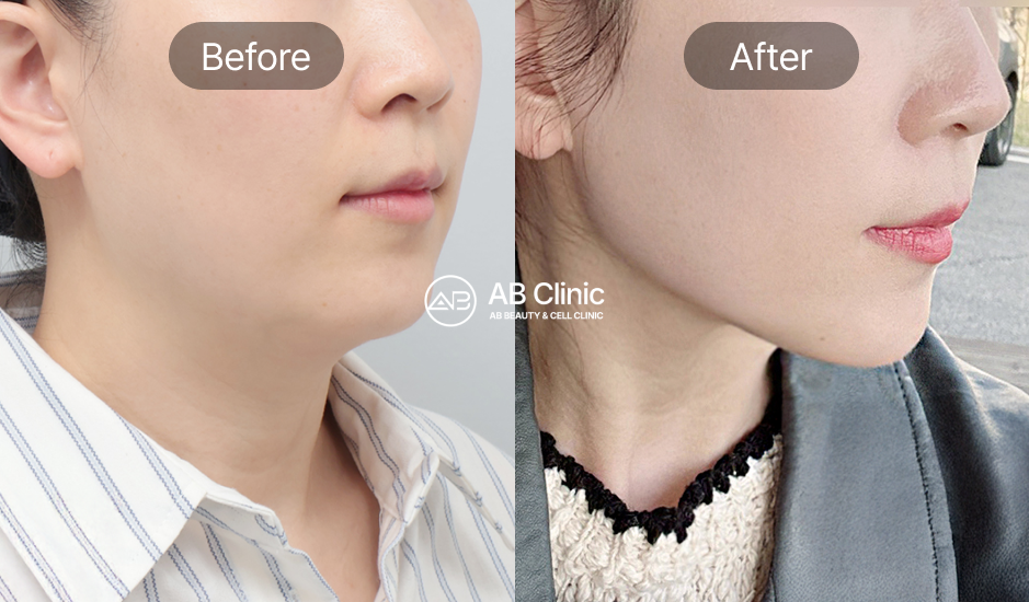 ウルセラによるフェイスライン引き締め・ハリ改善ビフォーアフター
