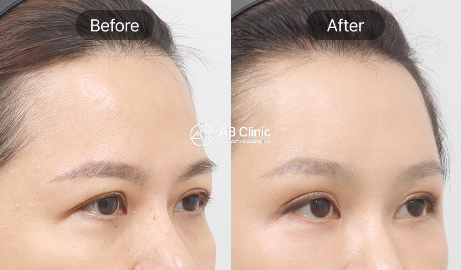 アイサーマジによる目元のたるみ・小ジワ改善ビフォーアフター