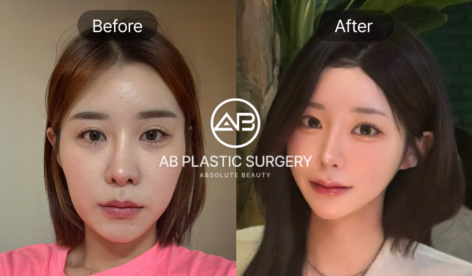 輪郭3点整形のビフォーアフター比較。頬骨・エラ・顎先のバランスを整えることで、小顔で女性らしい印象に変化した症例