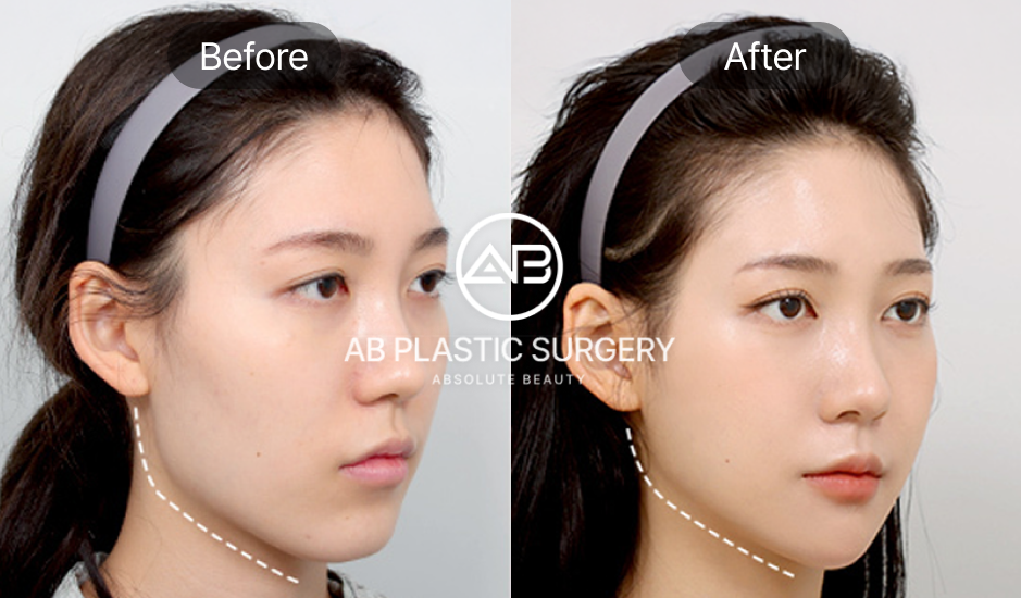 輪郭3点整形による横顔ビフォーアフター