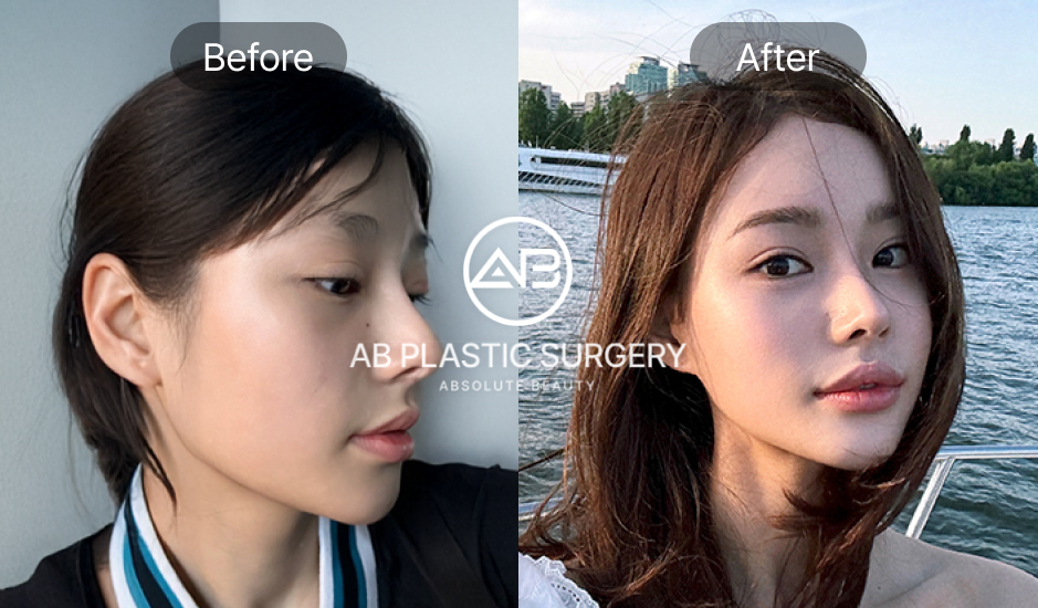 輪郭3点整形による自然なビフォーアフター