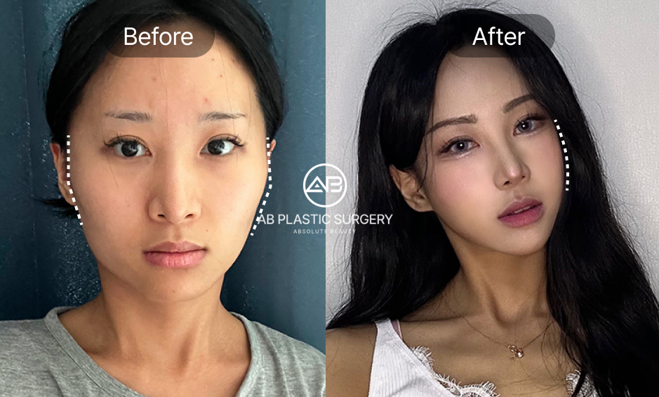 輪郭3点整形の術前術後比較。左右の顔幅とバランスが整い、滑らかなフェイスラインを実現