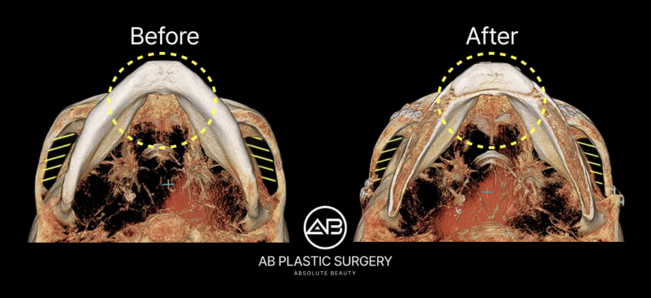 輪郭3点整形による顎先の術前術後CT（下部視点）。下顎のカーブと広がりが改善