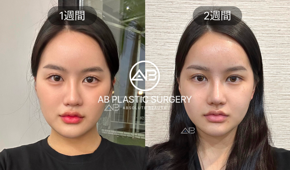 輪郭3点整形のダウンタイム経過（1週間・2週間）