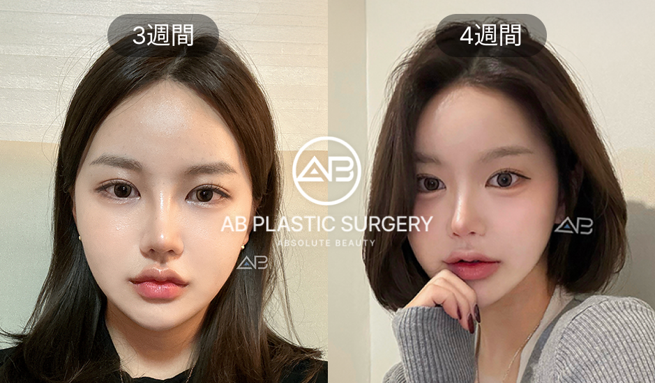 輪郭3点整形のダウンタイム3〜4週目