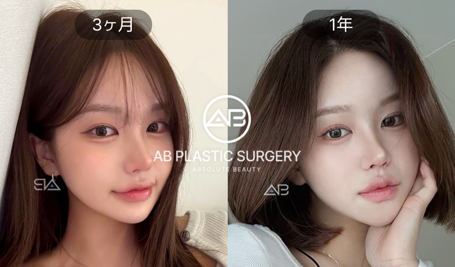 輪郭3点整形の最終結果（3ヶ月・1年後）